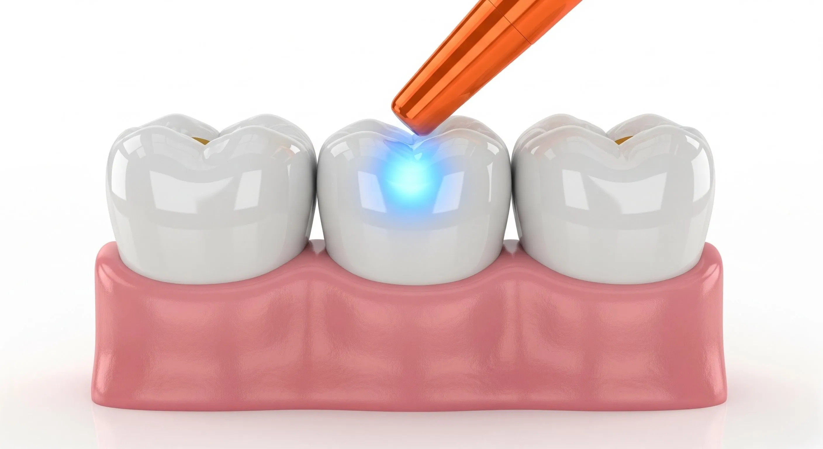 Composite Fillings Cost and Pricing Information in Lexington